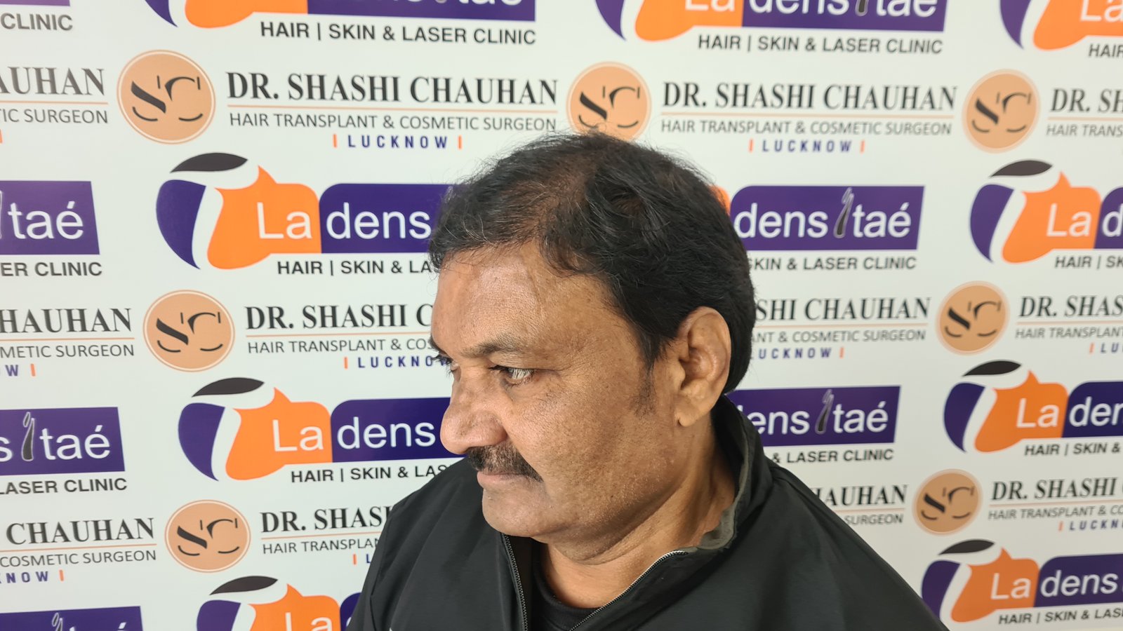 AK Singh After Hair Transplant
